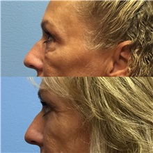Eyelid Surgery After Photo by Jason Petrungaro, MD, FACS; Munster, IN - Case 31333