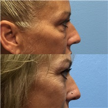 Eyelid Surgery Before Photo by Jason Petrungaro, MD, FACS; Munster, IN - Case 31333