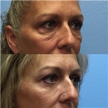 Eyelid Surgery Before Photo by Jason Petrungaro, MD, FACS; Munster, IN - Case 31333