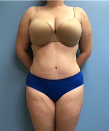 Tummy Tuck After Photo by Jason Petrungaro, MD, FACS; Munster, IN - Case 31339