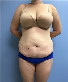 Tummy Tuck Before Photo by Jason Petrungaro, MD, FACS; Munster, IN - Case 31339