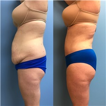 Tummy Tuck After Photo by Jason Petrungaro, MD, FACS; Munster, IN - Case 31339