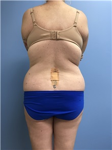 Tummy Tuck Before Photo by Jason Petrungaro, MD, FACS; Munster, IN - Case 31339