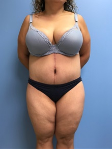 Body Lift After Photo by Jason Petrungaro, MD, FACS; Munster, IN - Case 31340