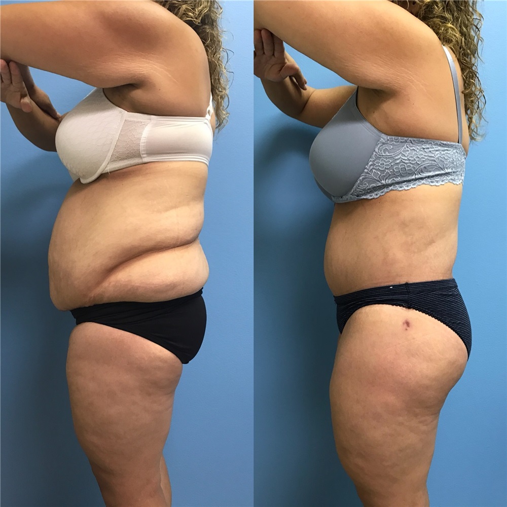 Body Lift Before and After Photos by Jason Petrungaro, MD, FACS
