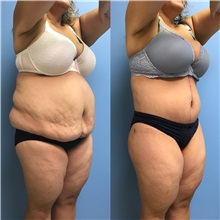 Body Lift Before Photo by Jason Petrungaro, MD, FACS; Munster, IN - Case 31340