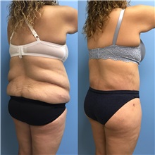 Body Lift Before Photo by Jason Petrungaro, MD, FACS; Munster, IN - Case 31340