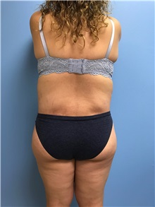 Body Lift After Photo by Jason Petrungaro, MD, FACS; Munster, IN - Case 31340