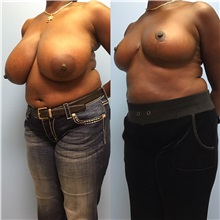 Breast Reduction After Photo by Jason Petrungaro, MD, FACS; Munster, IN - Case 31341
