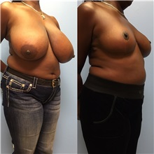 Breast Reduction Before Photo by Jason Petrungaro, MD, FACS; Munster, IN - Case 31341