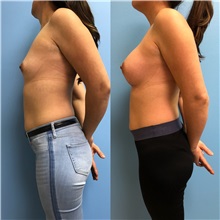 Breast Augmentation After Photo by Jason Petrungaro, MD, FACS; Munster, IN - Case 31356