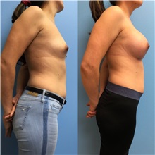 Breast Augmentation Before Photo by Jason Petrungaro, MD, FACS; Munster, IN - Case 31356