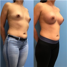 Breast Augmentation Before Photo by Jason Petrungaro, MD, FACS; Munster, IN - Case 31356