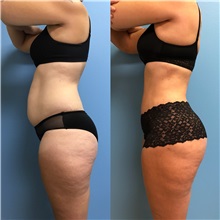 Tummy Tuck After Photo by Jason Petrungaro, MD, FACS; Munster, IN - Case 31357