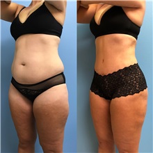 Tummy Tuck After Photo by Jason Petrungaro, MD, FACS; Munster, IN - Case 31357