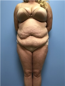 Tummy Tuck Before Photo by Jason Petrungaro, MD, FACS; Munster, IN - Case 31358