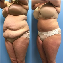 Tummy Tuck After Photo by Jason Petrungaro, MD, FACS; Munster, IN - Case 31358