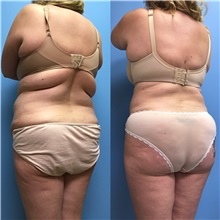Tummy Tuck After Photo by Jason Petrungaro, MD, FACS; Munster, IN - Case 31358