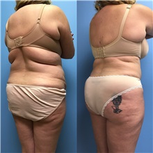 Tummy Tuck Before Photo by Jason Petrungaro, MD, FACS; Munster, IN - Case 31358
