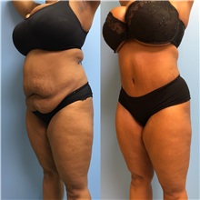 Tummy Tuck After Photo by Jason Petrungaro, MD, FACS; Munster, IN - Case 31361