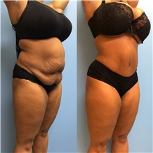 Tummy Tuck Before Photo by Jason Petrungaro, MD, FACS; Munster, IN - Case 31361