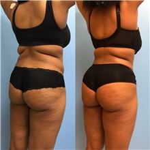 Tummy Tuck Before Photo by Jason Petrungaro, MD, FACS; Munster, IN - Case 31361