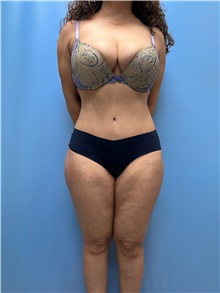 Tummy Tuck After Photo by Jason Petrungaro, MD, FACS; Munster, IN - Case 48168