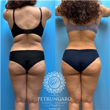 Tummy Tuck Before Photo by Jason Petrungaro, MD, FACS; Munster, IN - Case 48168