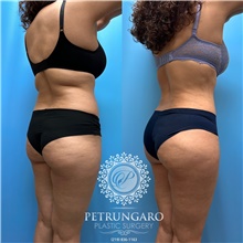 Tummy Tuck After Photo by Jason Petrungaro, MD, FACS; Munster, IN - Case 48168