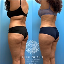 Tummy Tuck Before Photo by Jason Petrungaro, MD, FACS; Munster, IN - Case 48168