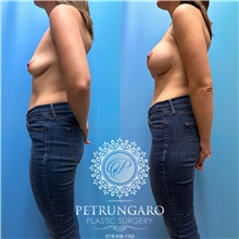 Breast Augmentation Before Photo by Jason Petrungaro, MD, FACS; Munster, IN - Case 48170
