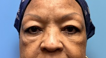 Eyelid Surgery Before Photo by Jason Petrungaro, MD, FACS; Munster, IN - Case 48183