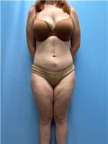 Body Lift After Photo by Jason Petrungaro, MD, FACS; Munster, IN - Case 48198