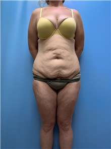 Body Lift Before Photo by Jason Petrungaro, MD, FACS; Munster, IN - Case 48198