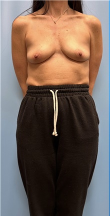 Breast Augmentation Before Photo by Jason Petrungaro, MD, FACS; Munster, IN - Case 48204
