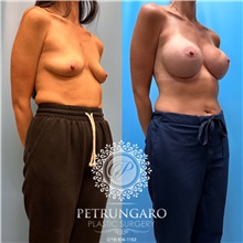 Breast Augmentation After Photo by Jason Petrungaro, MD, FACS; Munster, IN - Case 48204