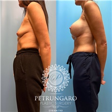 Breast Augmentation Before Photo by Jason Petrungaro, MD, FACS; Munster, IN - Case 48204