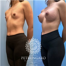 Breast Augmentation Before Photo by Jason Petrungaro, MD, FACS; Munster, IN - Case 48205