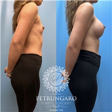Breast Augmentation After Photo by Jason Petrungaro, MD, FACS; Munster, IN - Case 48205