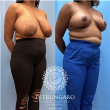 Breast Reduction After Photo by Jason Petrungaro, MD, FACS; Munster, IN - Case 48206