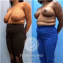 Breast Reduction Before Photo by Jason Petrungaro, MD, FACS; Munster, IN - Case 48206