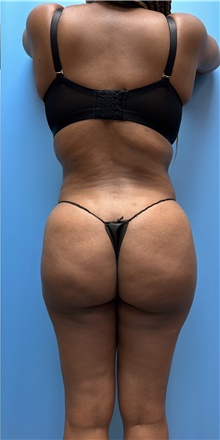 Buttock Lift with Augmentation After Photo by Jason Petrungaro, MD, FACS; Munster, IN - Case 48207