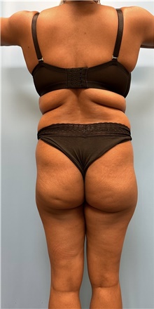 Buttock Lift with Augmentation Before Photo by Jason Petrungaro, MD, FACS; Munster, IN - Case 48207