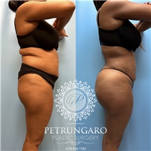 Buttock Lift with Augmentation After Photo by Jason Petrungaro, MD, FACS; Munster, IN - Case 48207