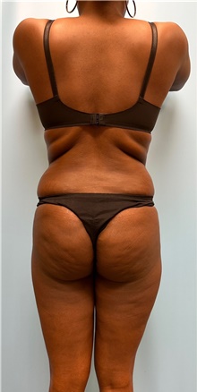 Buttock Lift with Augmentation Before Photo by Jason Petrungaro, MD, FACS; Munster, IN - Case 48208