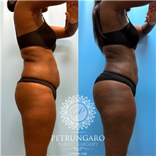 Buttock Lift with Augmentation After Photo by Jason Petrungaro, MD, FACS; Munster, IN - Case 48208