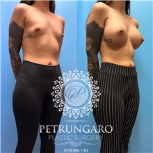 Breast Augmentation After Photo by Jason Petrungaro, MD, FACS; Munster, IN - Case 48211
