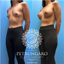 Breast Augmentation Before Photo by Jason Petrungaro, MD, FACS; Munster, IN - Case 48211