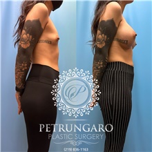 Breast Augmentation After Photo by Jason Petrungaro, MD, FACS; Munster, IN - Case 48211