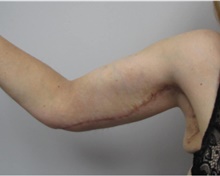 Arm Lift After Photo by Sara Dickie, MD; Morton Grove, IL - Case 43152